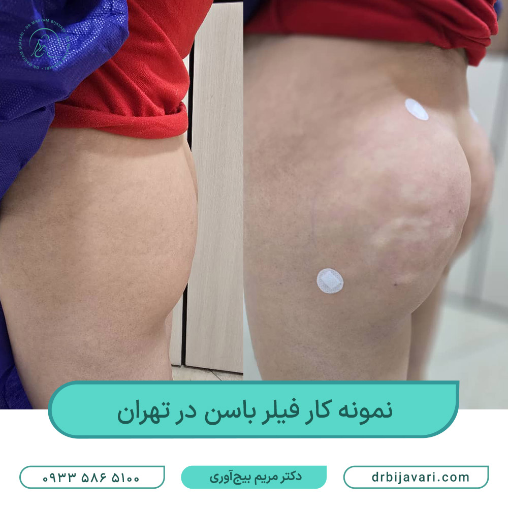 فیلر باسن در تهران فیلر باسن در تهران
