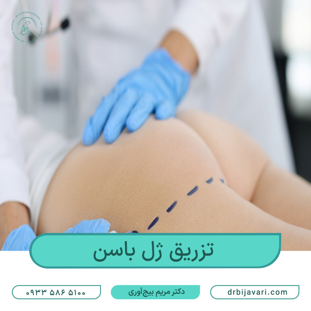 تزریق ژل باسن و هزینه انجام آن در سال ۱۴۰۳